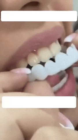 Royal smile®:  - Set 2 Pzs (Superior e Inferior)